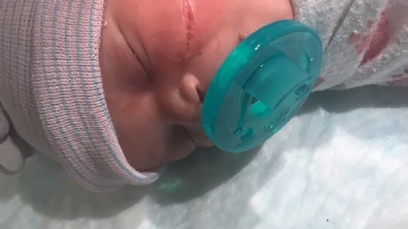 Направиха 13 шева на лицето на бебе след секцио