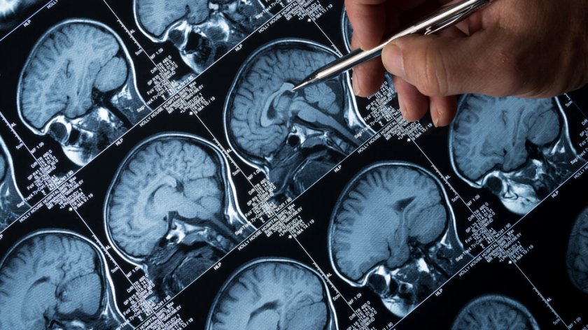 Учени откриха първопричината за болестта на Алцхаймер