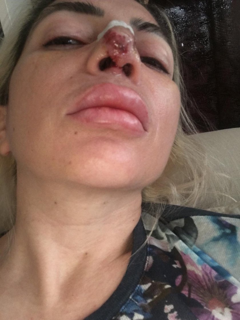Млада жена е обезобразена след ринопластика, завършила с некроза на носа
