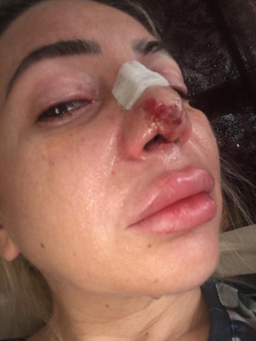 Млада жена е обезобразена след ринопластика, завършила с некроза на носа