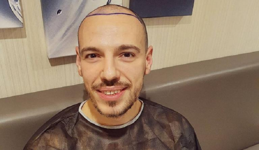 Даниел Петканов си присади коса преди около две години, но