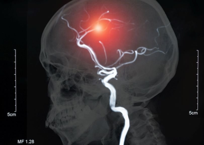 За опасно последствие от прекаран ковид съобщи шефът на Клиниката