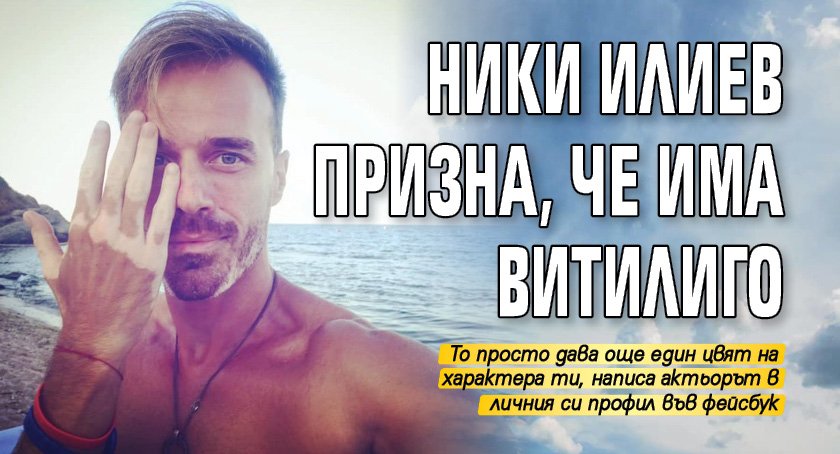 Ники Илиев призна, че има витилиго