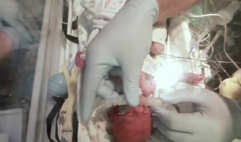 Чудо! Български лекари поставиха стент на новородения Виктор