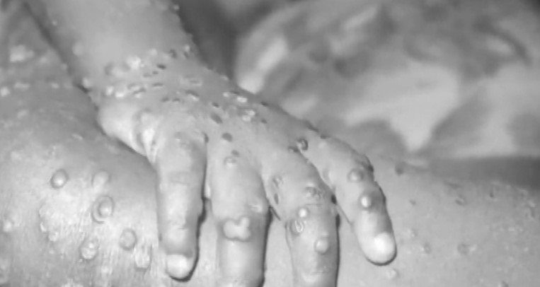 Евакуираха хотел "Бохеми" в Слънчев бряг заради пожар