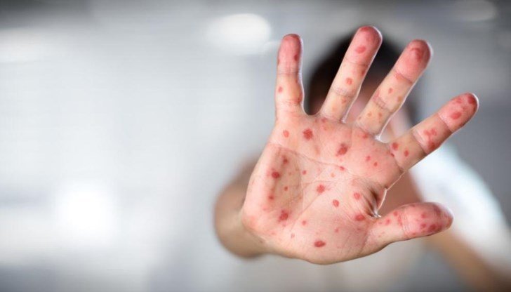 Рязък скок в броя на случаите на варицела у нас,