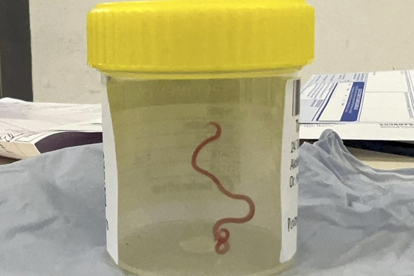 Гиганстски 8-сантиметров червей беше открит в мозъка на австралийка, съобщава