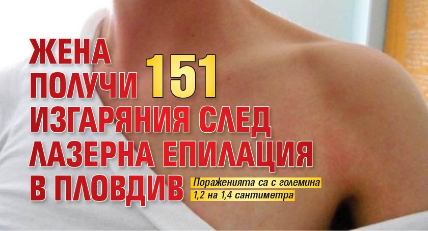 Жена получи 151 изгаряния след лазерна епилация в Пловдив