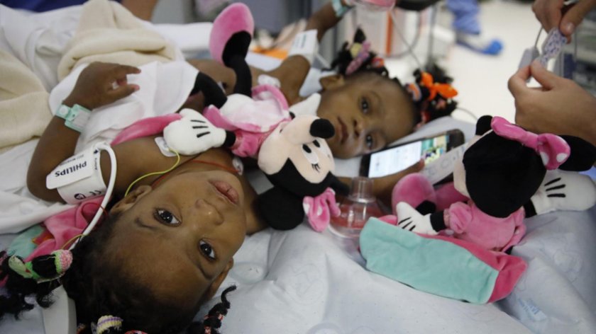 Разделиха сиамски близначки в лионска болница
