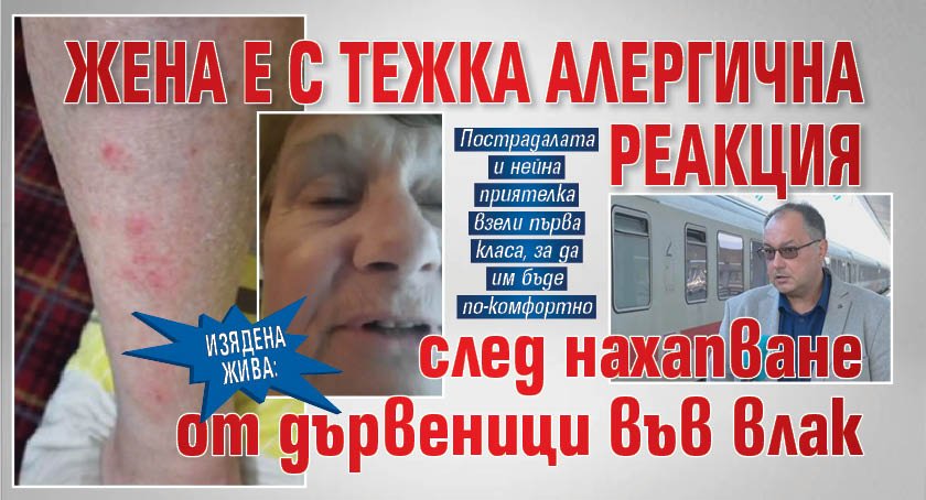 Изядена жива: Жена е с тежка алергична реакция след нахапване от дървеници във влак