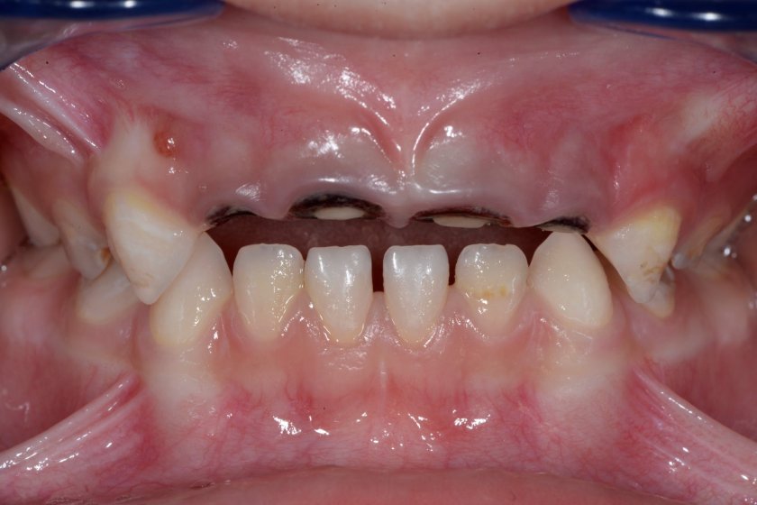 Развалени зъби мъчат над 90% от децата ни, сочат данни