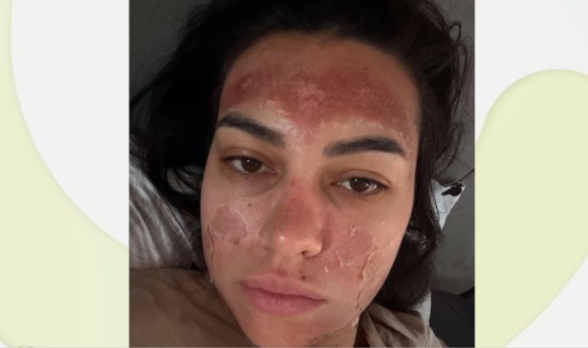 Десетки се оказаха пострадалите от козметичката с "билковия пилинг"