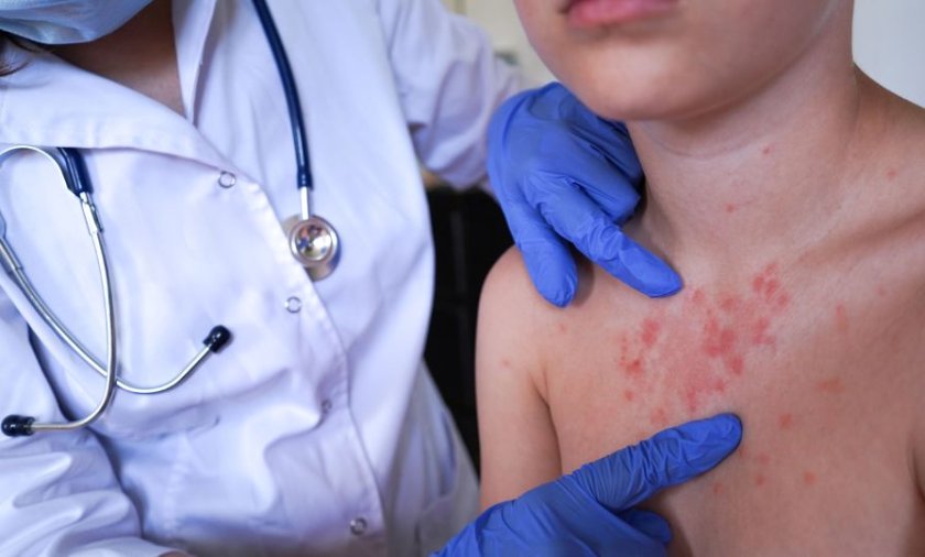 Нови 30 случая на морбили засякаха у нас между 6 и 12 април