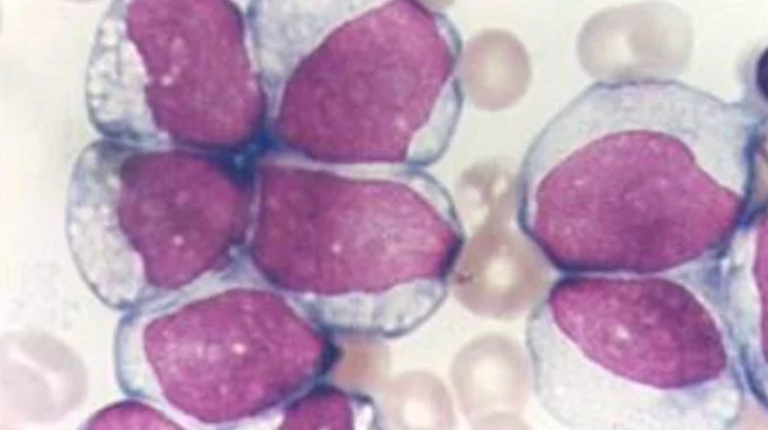 Трансплантираха бебенце с левкемия, вече е добре 