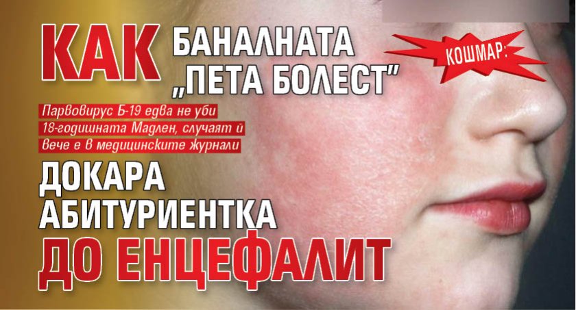 КОШМАР: Как баналната "пета болест" докара абитуриентка до енцефалит