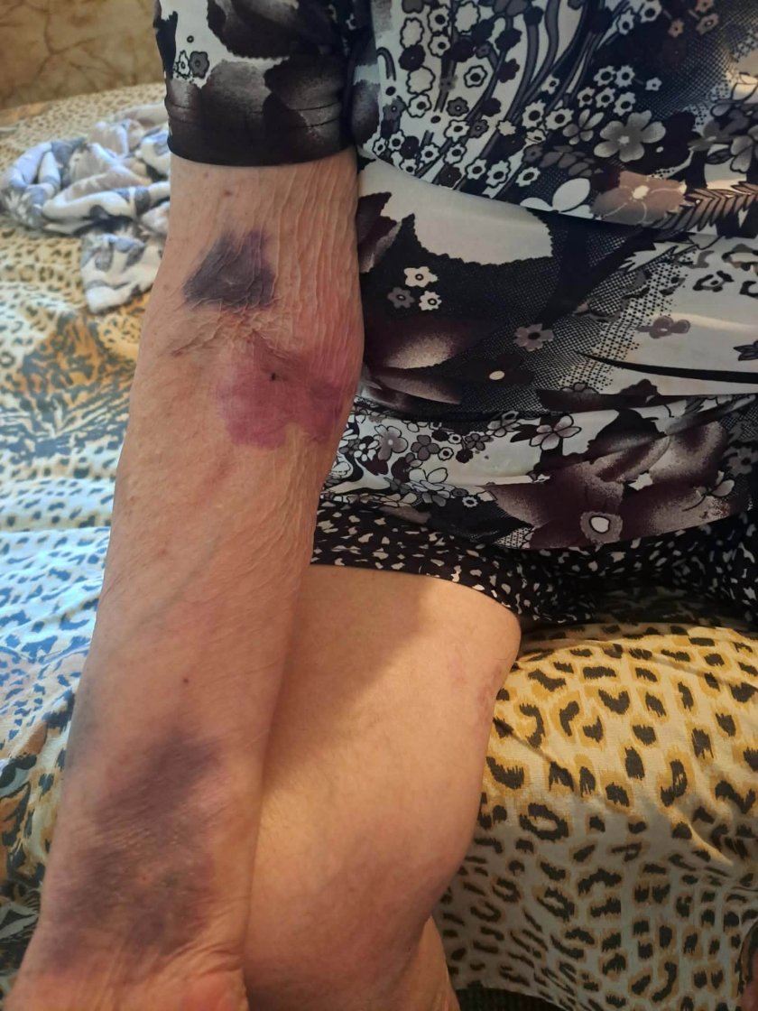 Жена влезе с пневмония в пернишката болница, излезе обезобразена