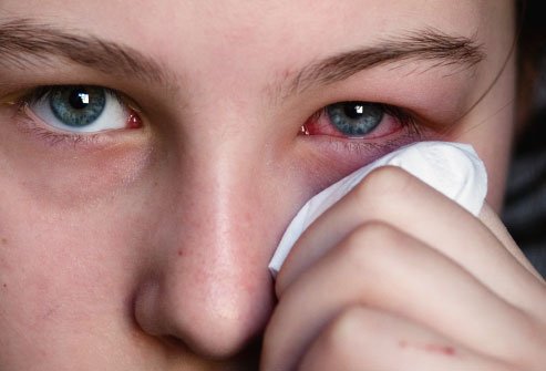 Нов симптом на коронавируса - възпалени очи 