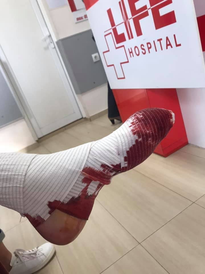 Бургаски медици върнаха младеж с кървящ крак 