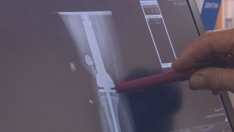 Уникална операция: Лекари спасиха живота на 13-годишно дете със специална протеза