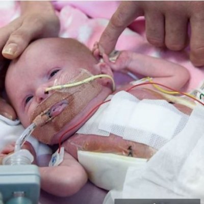 Спасиха бебе с трансплантация на сърце