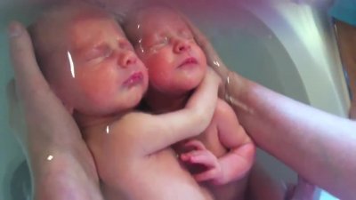 Спасиха близанци чрез кръвопреливане в утробата