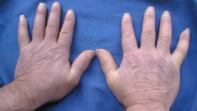 Трансплантираха ръце на мъж с рядко заболяване във Великобритания