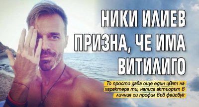 Ники Илиев призна, че има витилиго