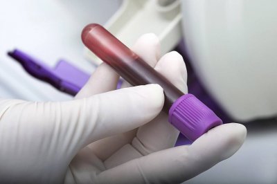 Революционен кръвен тест открива множество безсимптомни видове рак