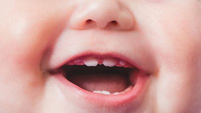Над 40  от децата на възраст 2 3 години имат проблеми със зъбите