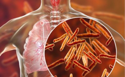 Туберкулозата е на първо място по разпространение и смъртност в