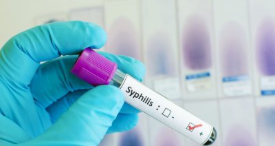 10-и случай на сифилис в област Монтана от началото на годината