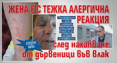 Изядена жива: Жена е с тежка алергична реакция след нахапване от дървеници във влак