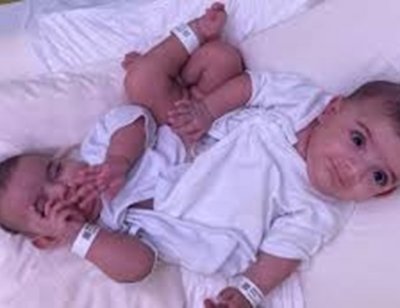 Хирурзи от Саудитска Арабия разделиха сиамски близнаци 