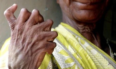 Обявиха за вещица индийка с 31 пръста