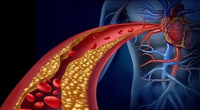 Генна терапия озаптява „лошия“ холестерол