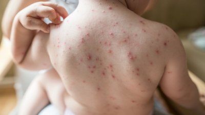 Ваксината срещу варицела - задължителна от юли!