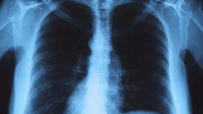 Жена почина от легионерска болест в Бургас