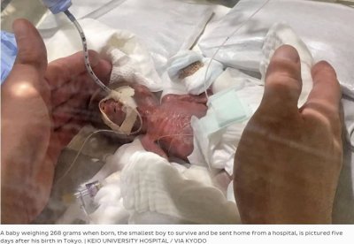 Бебе, родено 258 грама, оцеля в Япония