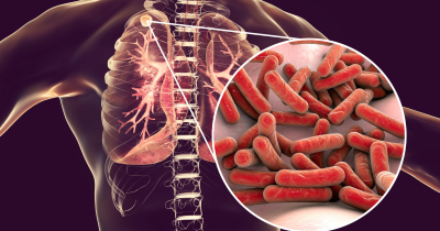 Безплатни консултации за туберкулоза в София