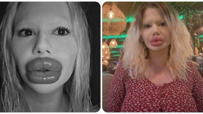 Българското Барби няма да спира с хилаурона