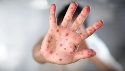 И Варна пламва с морбили