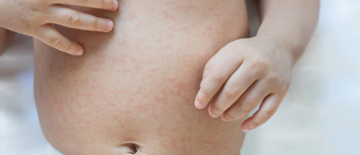 150 станаха морбили случаите в страната