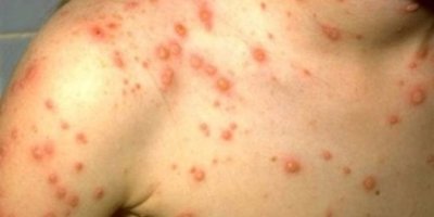 225 са случаите на морбили у нас, най-засегната е Враца
