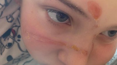 Популярни антистрес играчки известни като скуиши може да предизвикат изгаряния