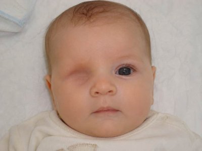 ШОКИРАЩО: Дете се роди без едно око, куп лекари не видели аномалията